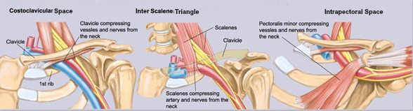 Thoracic Outlet Areas Of Compression