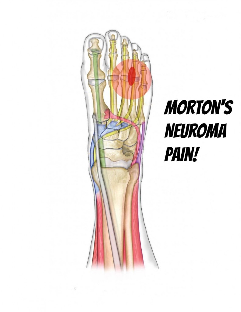 Morton’s Neuroma Self Help Tips, Treatment and Prevention From The Barefoot Running Doctor at